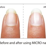 MicroNail Before and After